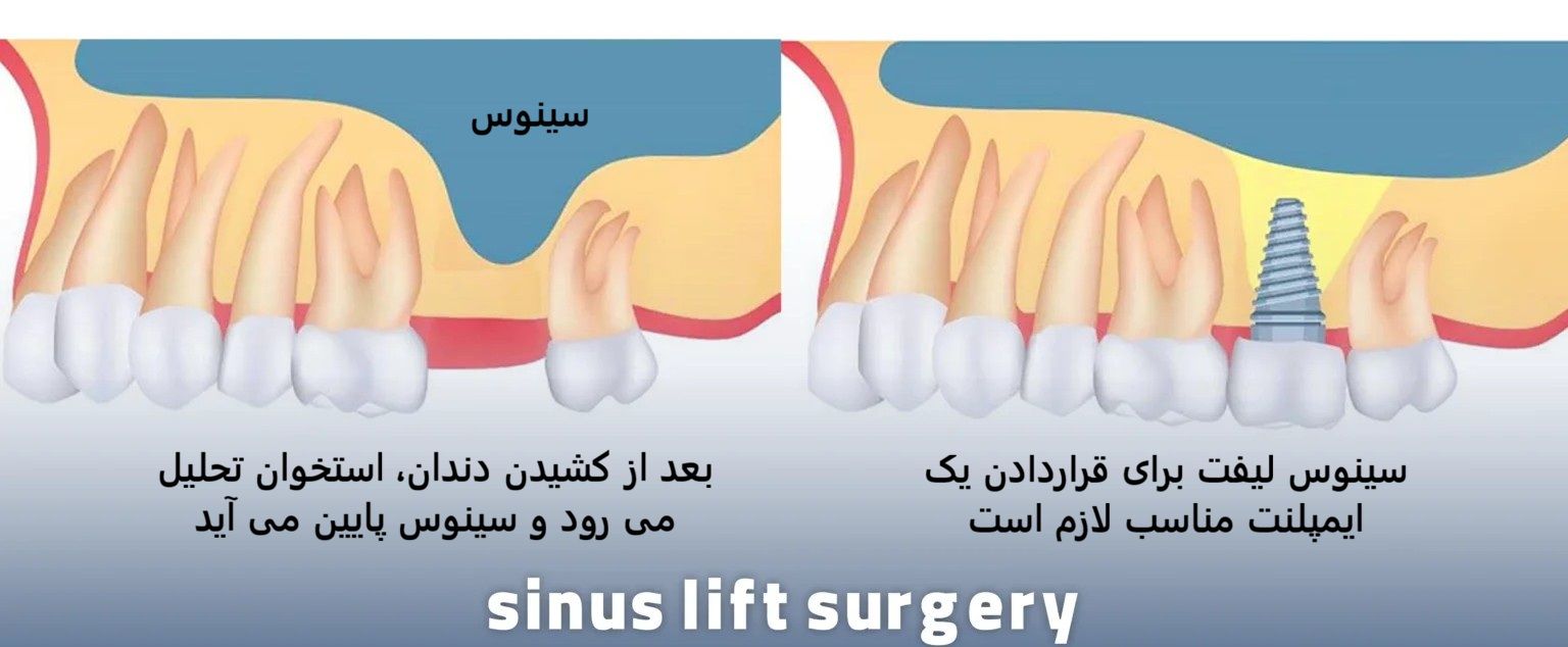 جراحی سینوس لیفت