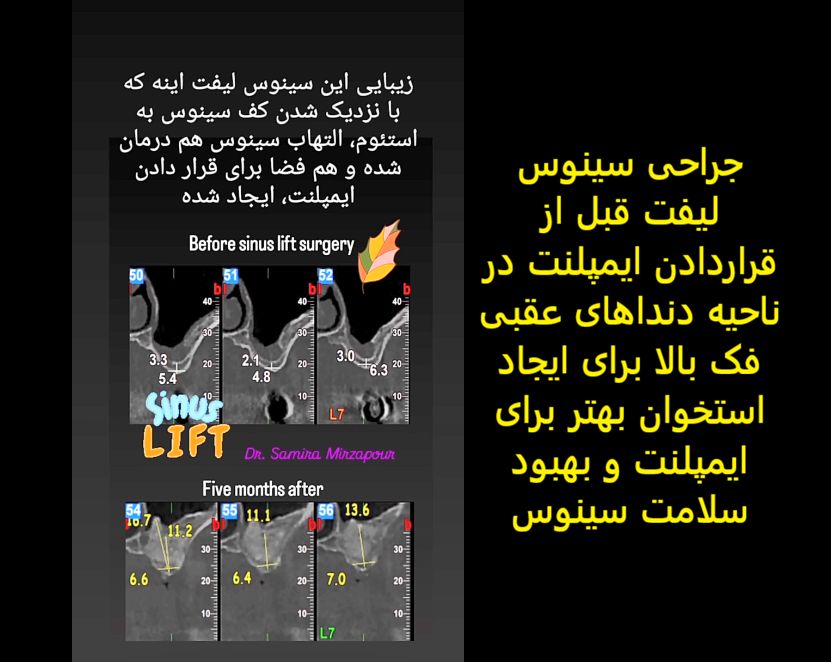 جراحی سینوس لیفت — تصویر بالینی